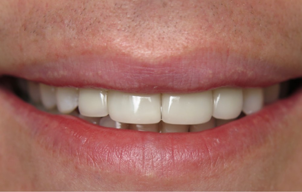 Teeth Whitening Specialist Charlotte, NC